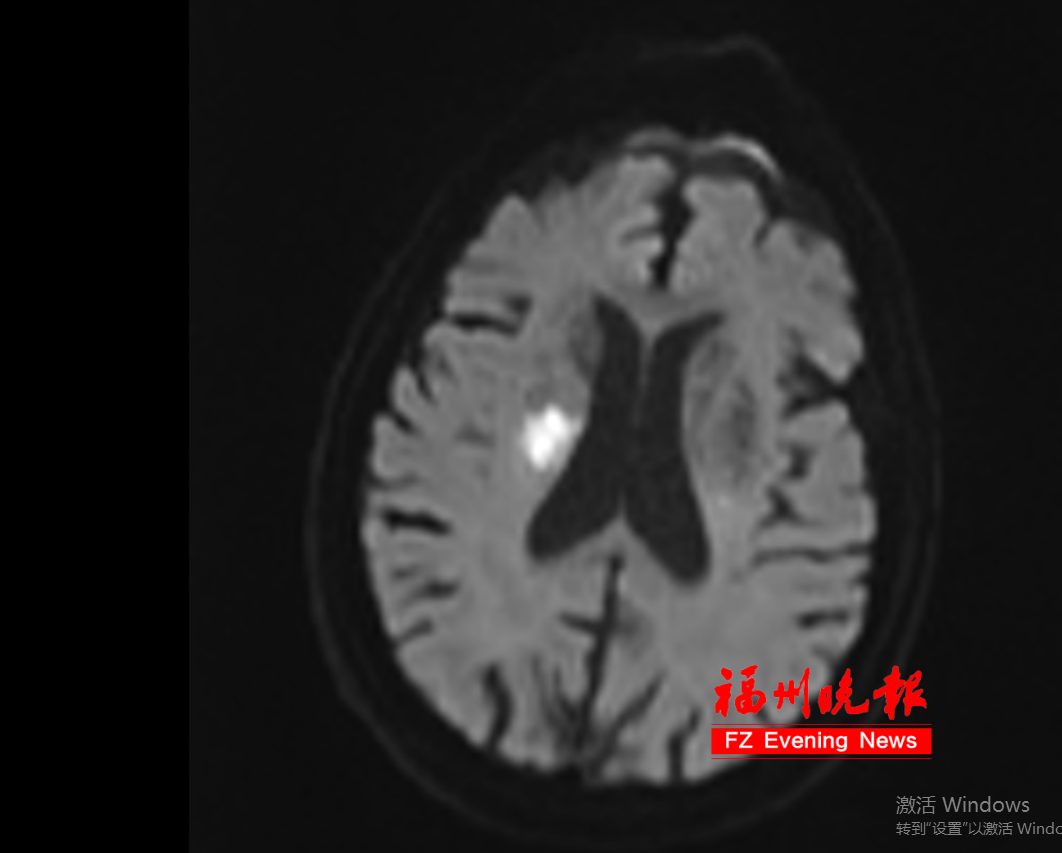 感冒后想“扛一扛” 男子突发脑梗死