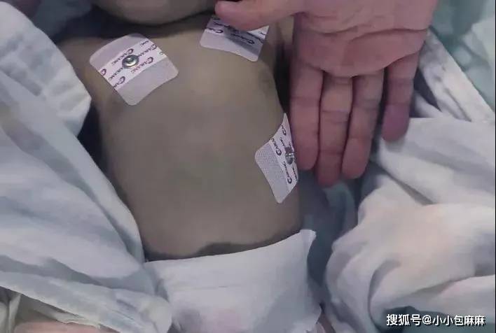 婴儿误食隔夜萝卜水泡奶中毒抢救