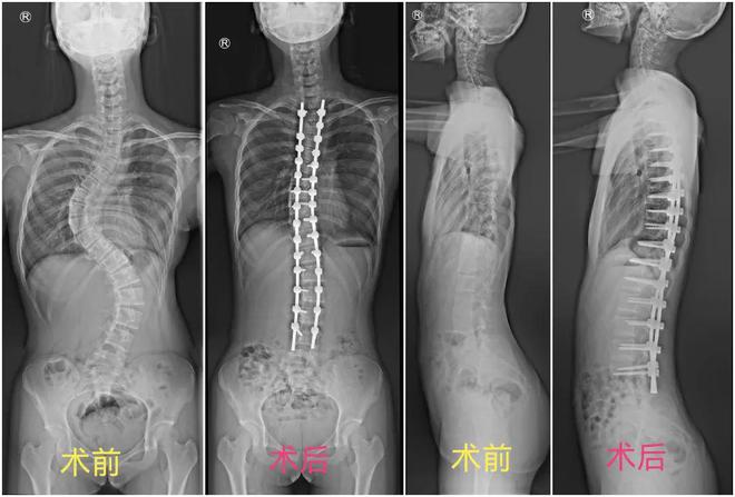 男子成年后长高20cm 骨龄仅13到15岁