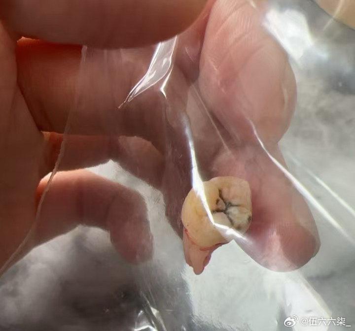医学生自拔智齿 手起牙落面不改色