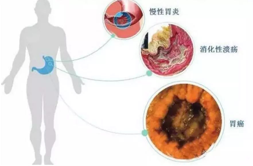 蓝莓肚脐眼的霉菌可引发急性肠胃炎