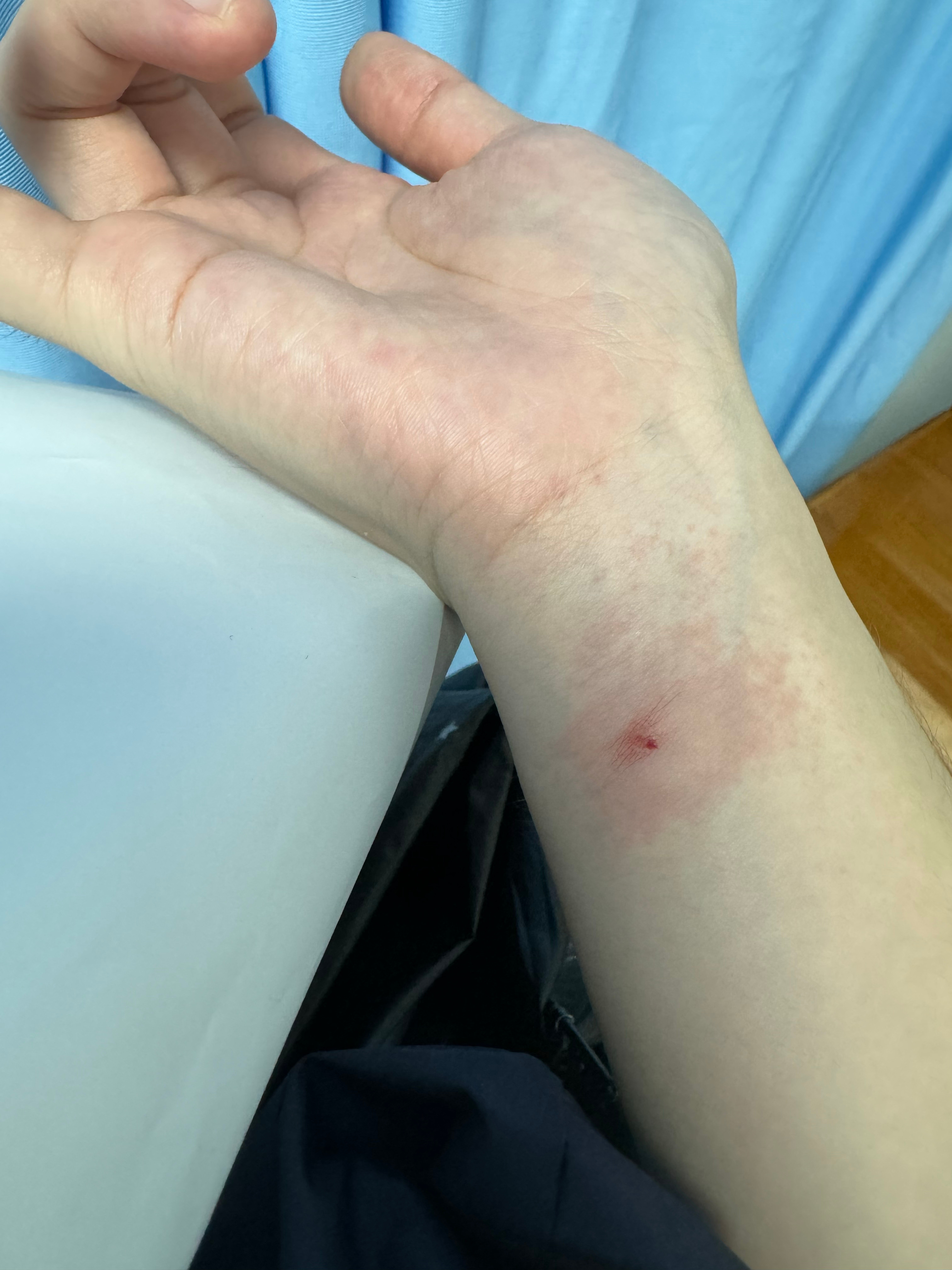 输液过敏离世女生曾要求皮试被拒