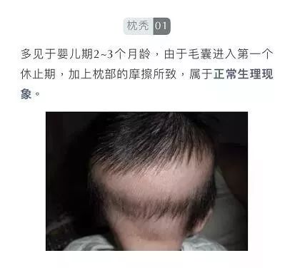 3岁女童突然脱发 查出铊中毒